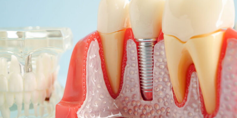 dental implants west jordan dentist